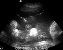 Fetal akinesia deformation sequence image