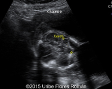 Cystic hygroma, hydrops, 28 weeks image