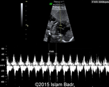 A case of supraventricular tachycardia – pre-terminal recording of hemodynamics by STIC image
