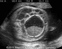 Ovarian cyst, 30-38 weeks image