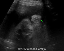Ovarian cyst, in utero regression image