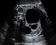 Ovarian cyst, bilateral, spontaneous regression image