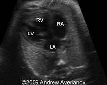 Tricuspid atresia, ventricular septal defect and interrupted aortic arch image