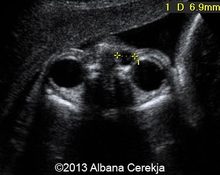Dacryocystocele, unilateral, regression, in a twin pregnancy image