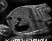 Duodenal atresia image