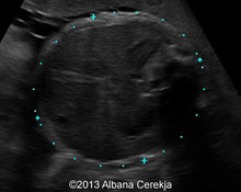 Adenomyomatosis of the gallbladder image