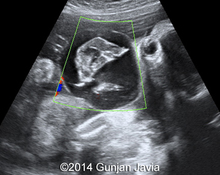 Vanishing twin imitating fetal chest mass image