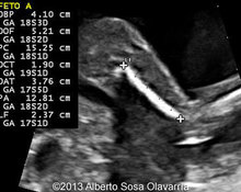 Partial molar pregnancy with normal diploid fetus image