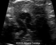 S-shaped ductus arteriosus image