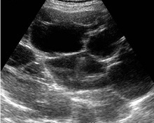 Multicystic liver disease and pregnancy image