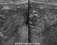 Neuroblastoma, prenatal regression image