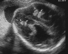 Fetal toxoplasmosis infection image