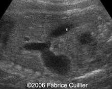 Duodenal atresia image