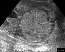 Sacrococcygeal teratoma, Type II image