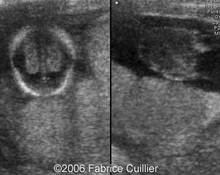 Acrania in one fetus of dichorionic pregnancy image