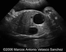 Duodenal atresia - male image