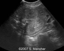 Polycystic renal disease image