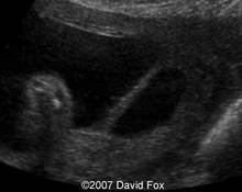Uterine synechia in pregnancy image