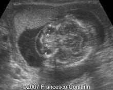 Amniotic band syndrome image