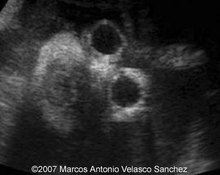 Anencephaly and cleft lip image