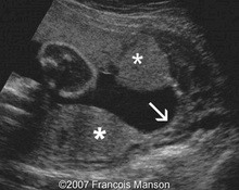 Low-lying incompletely bilobate placenta with vasa previa and velamentous insertion of the cord image