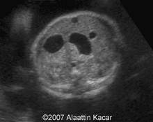 Duodenal atresia image