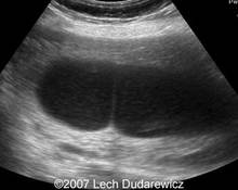Asherman syndrome, uterine synechia image
