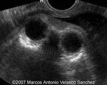 Acrania, craniorachischisis, 36 weeks image