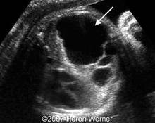 Cystic adenomatoid malformation of the lung, type I image