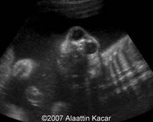 Anencephaly in one twin image