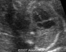 Ventricular septal defect image