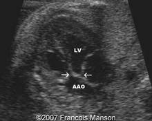 Aortic stenosis, valvular image