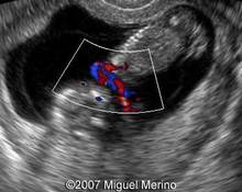 Umbilical cord around the fetal neck image