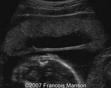 Circumvallate placenta, partial image