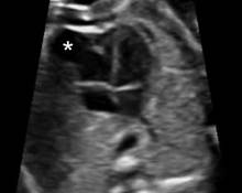 Diverticulum of the right ventricle image