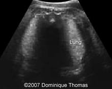 Fetal pneumonia image