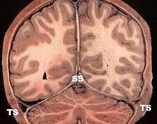 The intracranial venous sinuses (upper-posterior group) image