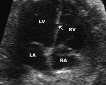 Ventricular septal defect, trabecular type image