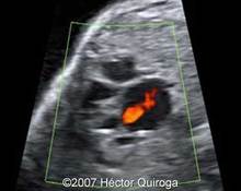 Aortic stenosis, critical image