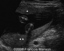 Bilobate placenta image