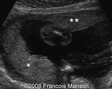 Succenturiate placenta image