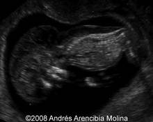 Partial trisomy 6q associated with hydrops and early fetal malformations image