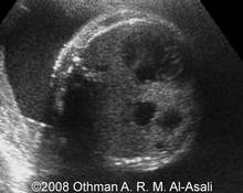 Congenital cystic adenomatoid malformation of the lungs, type I image