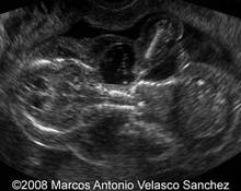 Cystic hygroma, 16 weeks image