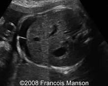 Ovarian cyst, hemorrhagic image
