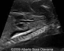 Interrupted aortic arch, type B image