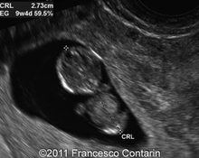 Trisomy 21, 12 weeks image