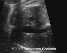 Tubular hypoplasia of the transverse aortic arch image