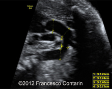 Coartation of the aorta image