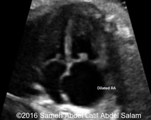 Pulmonary valve stenosis image